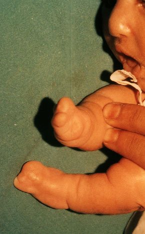 Deformed Iraqi baby caused by USA use of depleted uranium to hardened ammunition