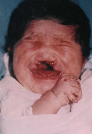 Deformed Iraqi baby caused by USA use of depleted uranium to hardened ammunition