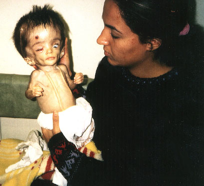 Deformed Iraqi baby caused by USA use of depleted uranium to hardened ammunition