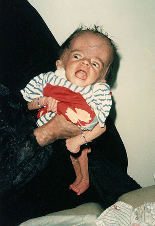 Deformed Iraqi baby caused by USA use of depleted uranium to hardened ammunition