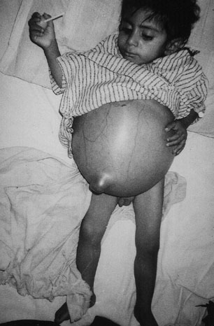 Deformed Iraqi baby caused by USA use of depleted uranium to hardened ammunition