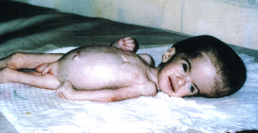 Deformed Iraqi baby caused by USA use of depleted uranium to hardened ammunition