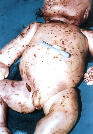 Deformed Iraqi baby caused by USA use of depleted uranium to hardened ammunition