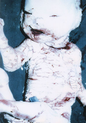 Deformed Iraqi baby caused by USA use of depleted uranium to hardened ammunition