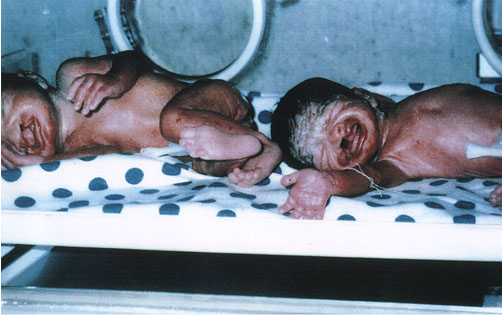 Deformed Iraqi baby caused by USA use of depleted uranium to hardened ammunition