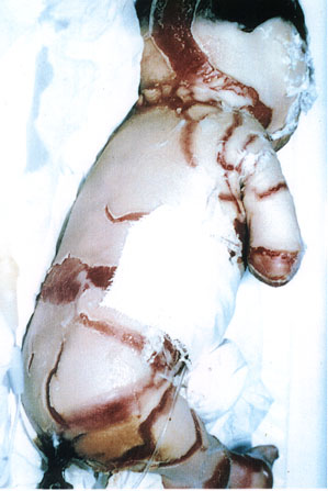 Deformed Iraqi baby caused by USA use of depleted uranium to hardened ammunition