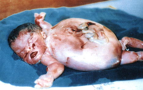 Deformed Iraqi baby caused by USA use of depleted uranium to hardened ammunition