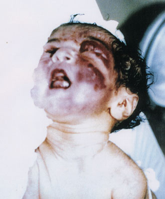 Deformed Iraqi baby caused by USA use of depleted uranium to hardened ammunition