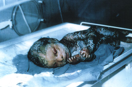 Deformed Iraqi baby caused by USA use of depleted uranium to hardened ammunition