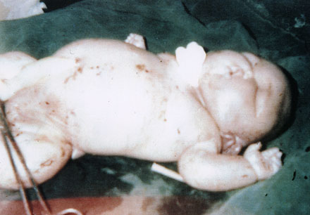 Deformed Iraqi baby caused by USA use of depleted uranium to hardened ammunition