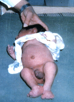 Deformed Iraqi baby caused by USA use of depleted uranium to hardened ammunition