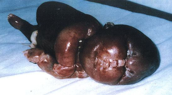 Deformed Iraqi baby caused by USA use of depleted uranium to hardened ammunition