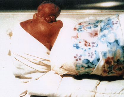 Deformed Iraqi baby caused by USA use of depleted uranium to hardened ammunition